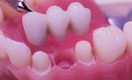 dental implants Austin