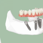 The Benefits Of All On Four Dental Implants
