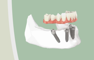 The Benefits Of All On Four Dental Implants