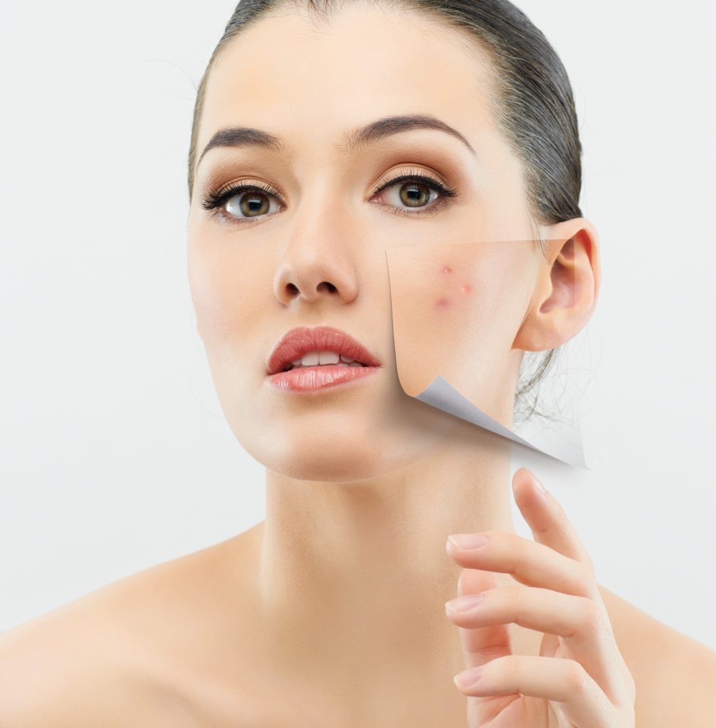 Top 10 Advanced Treatment For Acne