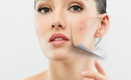 Top 10 Advanced Treatment For Acne