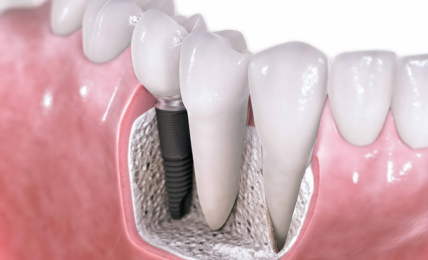 Significance Of Dental Implants