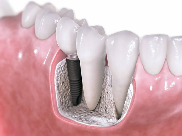 Significance Of Dental Implants