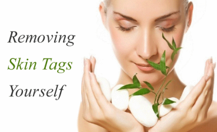 Skin Tags And Methods To Treat Them Effectively