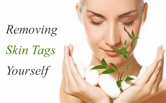 Skin Tags And Methods To Treat Them Effectively