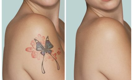 A Guide On Tattoo Removal