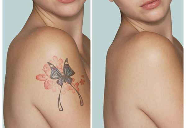 A Guide On Tattoo Removal