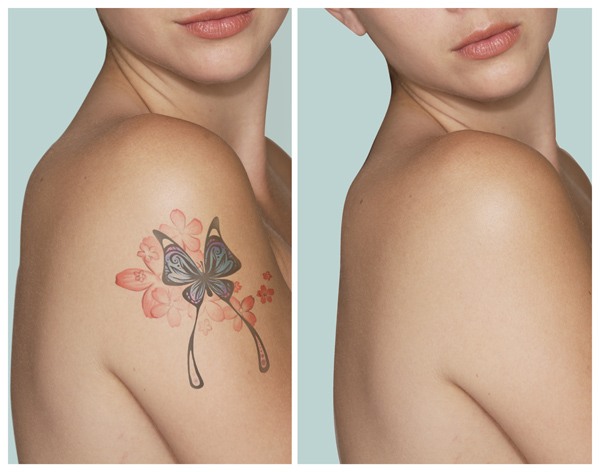 A Guide On Tattoo Removal