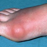 How To Treat and Manage A Gout Attack