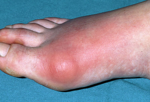 How To Treat and Manage A Gout Attack