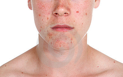 Skin Care: The Best Ways To Conceal Your Acne Problem