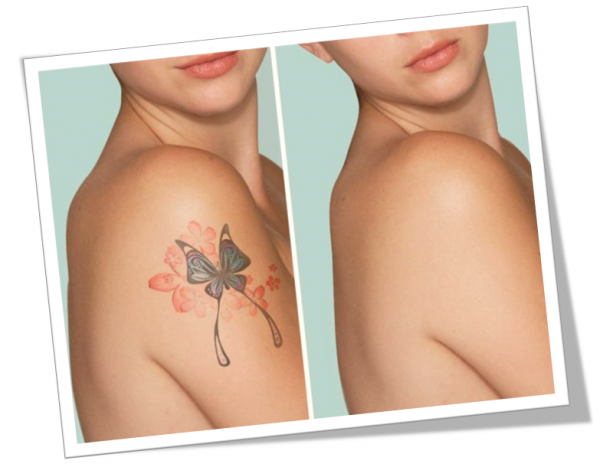 Essential Parameters and Considerations For Tattoo Removal In New York