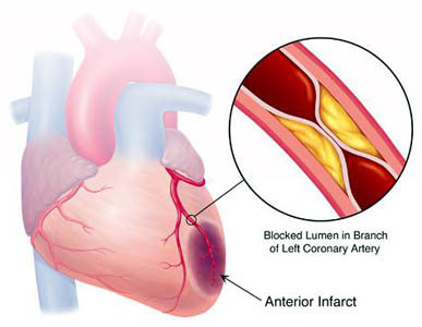 Treatment Options For Coronary Artery Disease