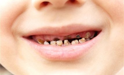How To Prevent Early Childhood Tooth Decay