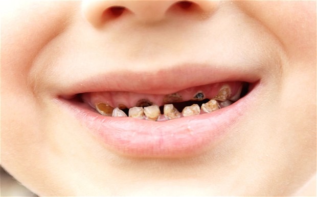 How To Prevent Early Childhood Tooth Decay