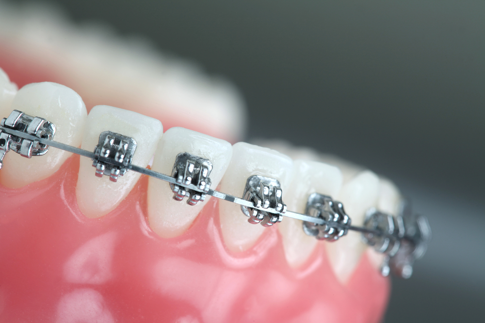 The Key Differences Between Adult Orthodontics and Kids' Orthodontics