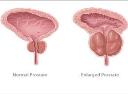 prostatitis