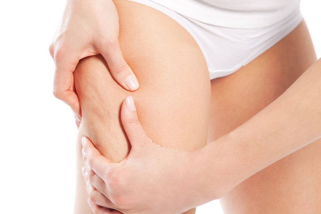 Types Of Cellulite and Their Treatment