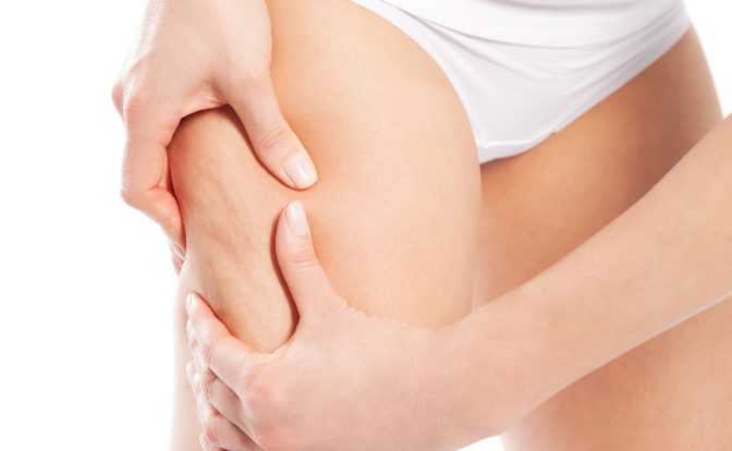 Types Of Cellulite and Their Treatment
