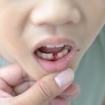 When Do Children's Teeth Fall Out