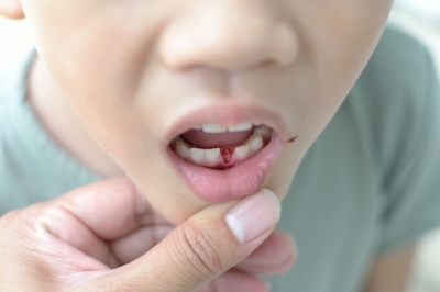 When Do Children's Teeth Fall Out