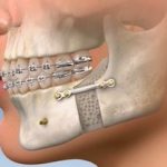 What Is Orthognathic Surgery?