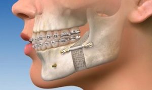 What Is Orthognathic Surgery?