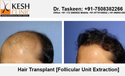 Learn About Important Measures About Hair Transplant