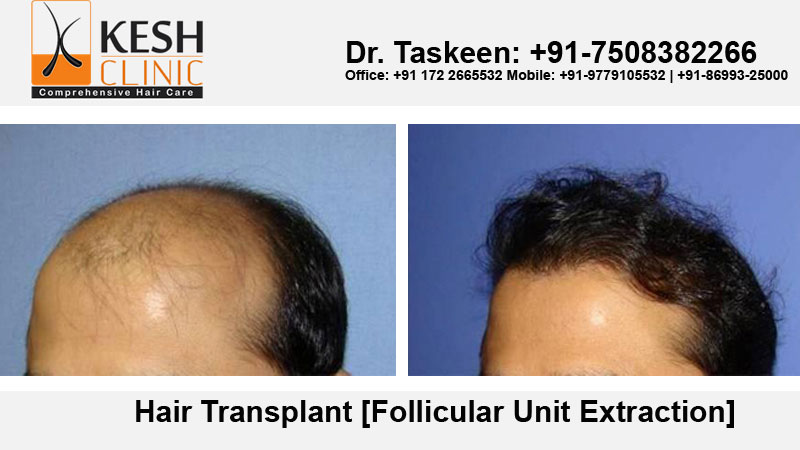 Learn About Important Measures About Hair Transplant