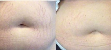 Good Riddance To Stretch Marks!