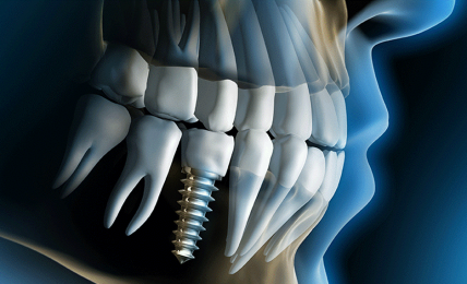 Why Should You Go For Dental Implants?