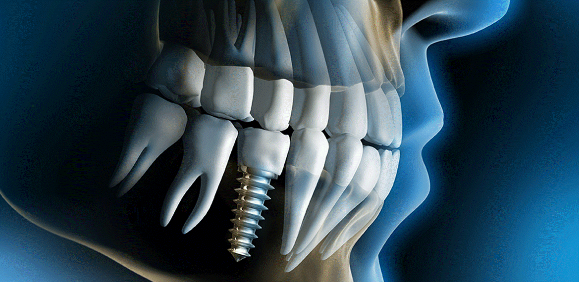Why Should You Go For Dental Implants?