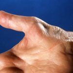 Everything You Need To Know About Carpal Tunnel Syndrome