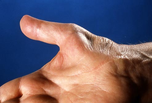 Everything You Need To Know About Carpal Tunnel Syndrome