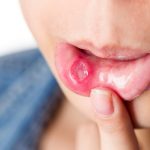 7 Ways To Get Rid Of Mouth Ulcers