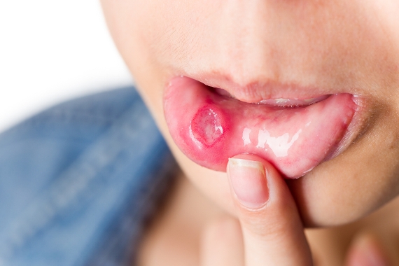 7 Ways To Get Rid Of Mouth Ulcers