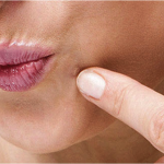 10 Natural Solutions To Permanently Get Rid Of Embarrassing Warts