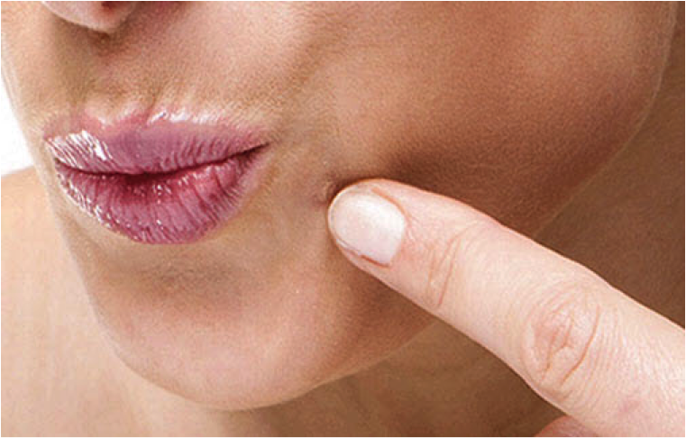 10 Natural Solutions To Permanently Get Rid Of Embarrassing Warts