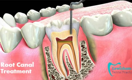 Endodontics-root-canal-treatment
