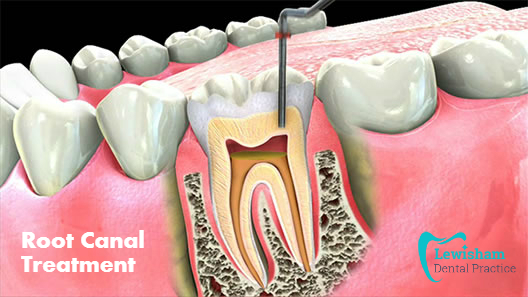 Everything One Needs To Know About Root Canal Treatment