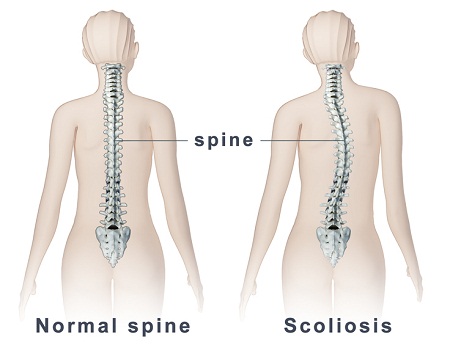 New Treatment Options For Those Diagnosed With Scoliosis