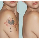 Tips and Advice On Laser Tattoo Removal
