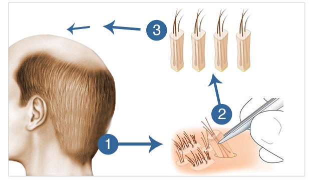 Techniques Used in Hair Transplantation