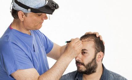 Techniques Used in Hair Transplantation