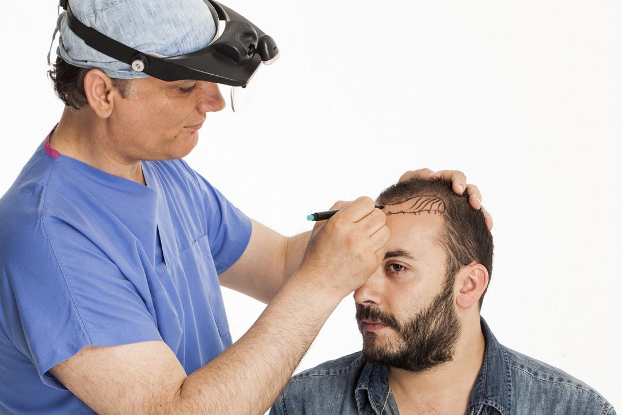 Techniques Used in Hair Transplantation