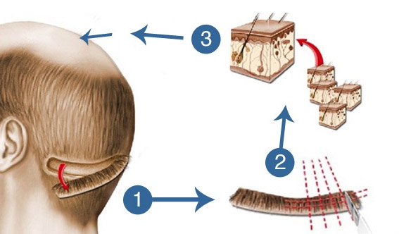 Techniques Used in Hair Transplantation