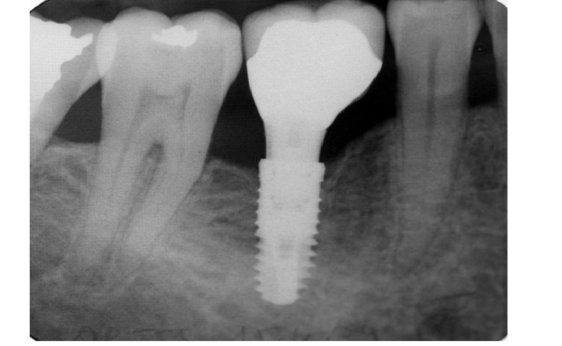 Missing Teeth! Dental Implants Are The Best Replacement Solution
