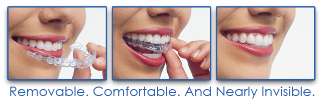 What Is Invisalign?