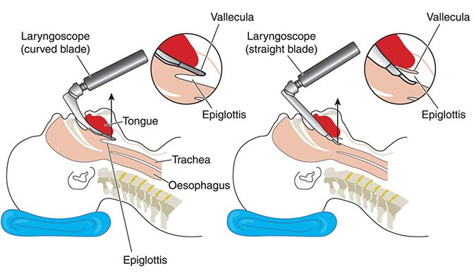 What Is Endotracheal Intubation And Why Is It Performed?