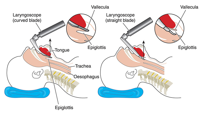 What Is Endotracheal Intubation And Why Is It Performed?